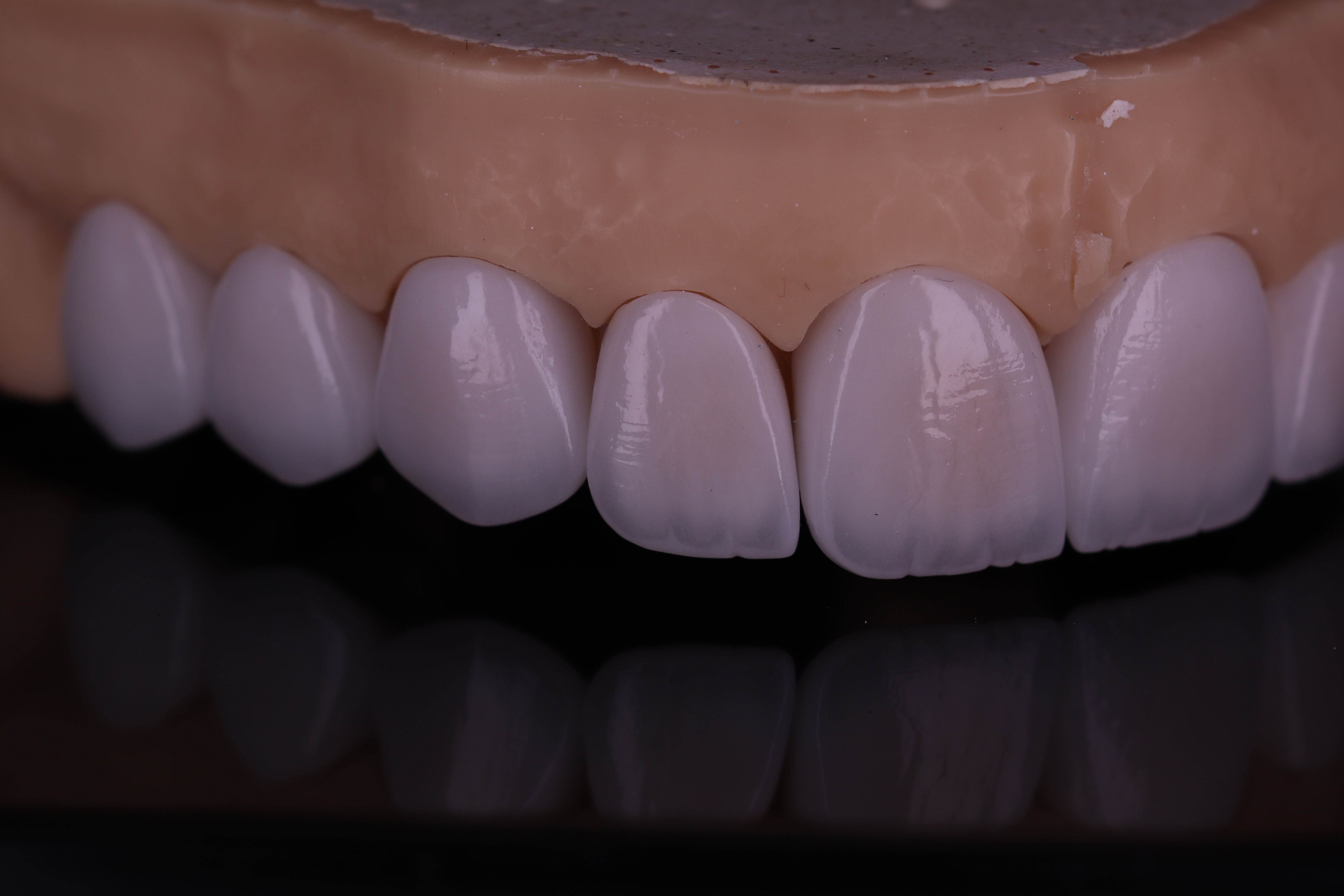 Ceramic Crowns