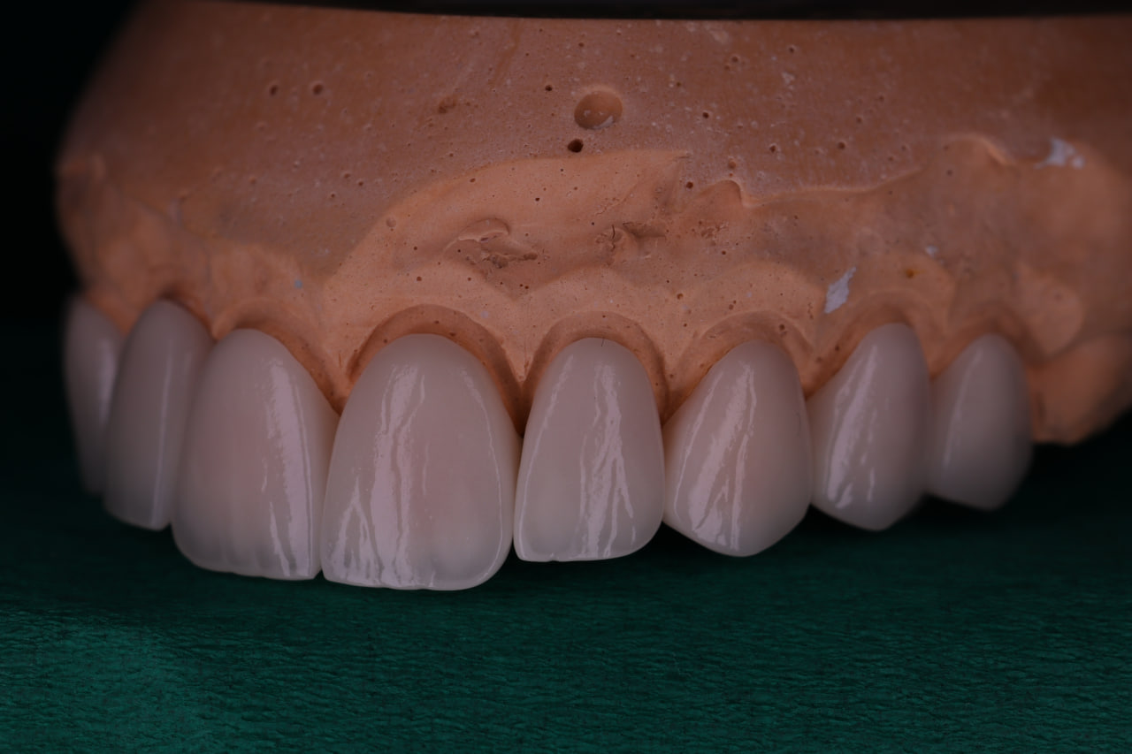 Zirconia Crowns
