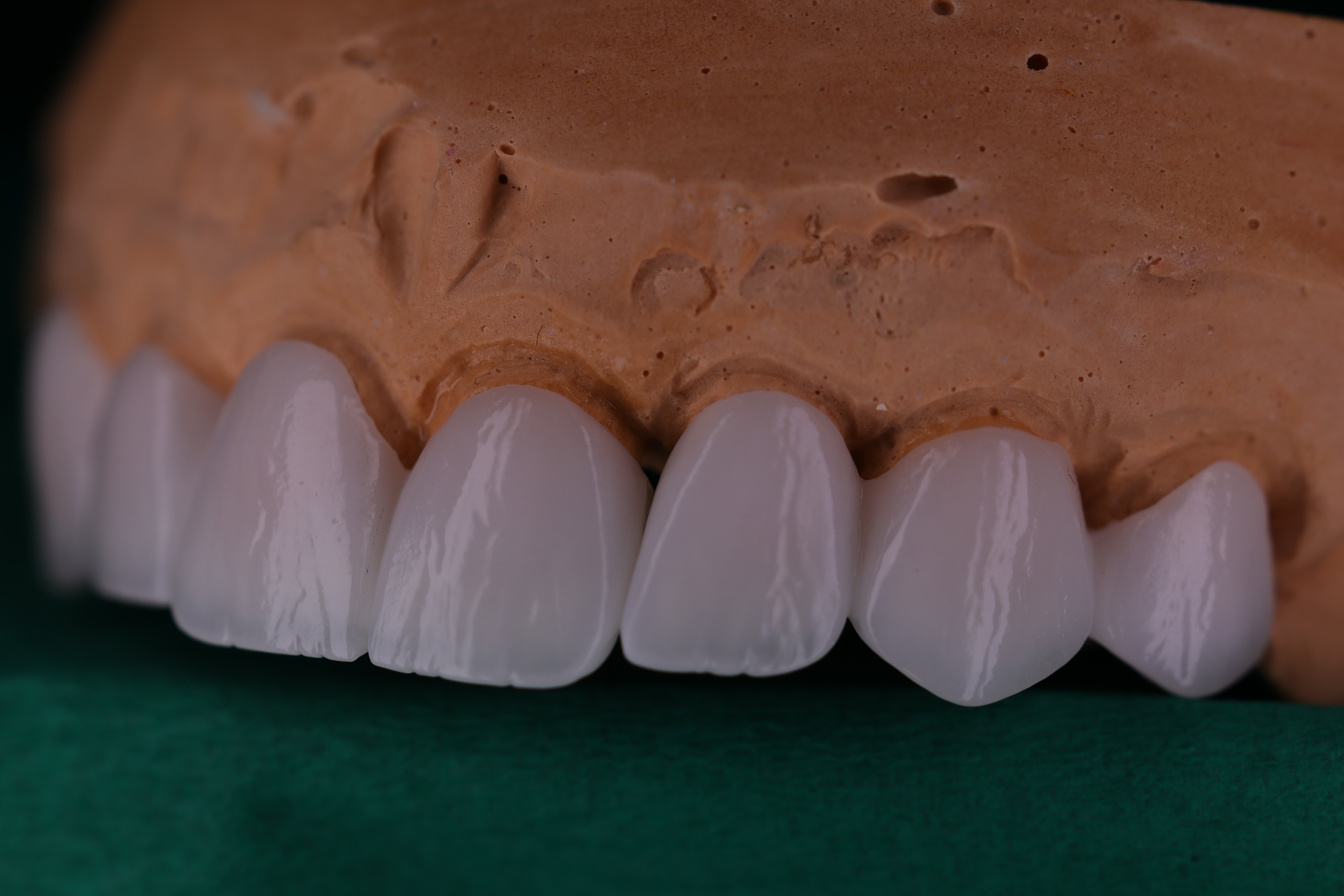Implant Crowns