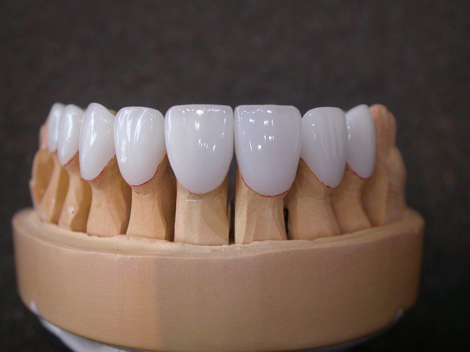 Veneers