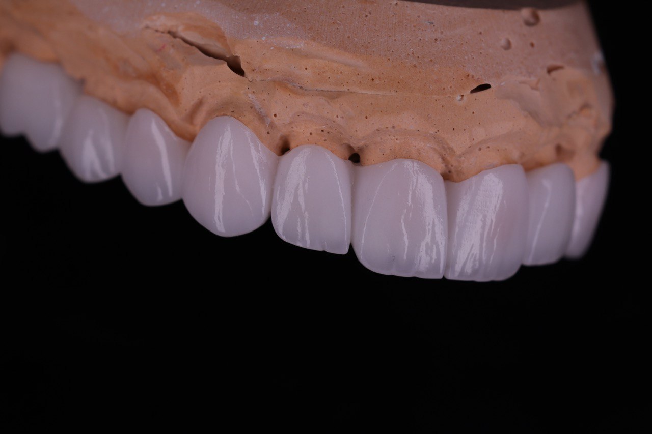 Zirconia Restorations