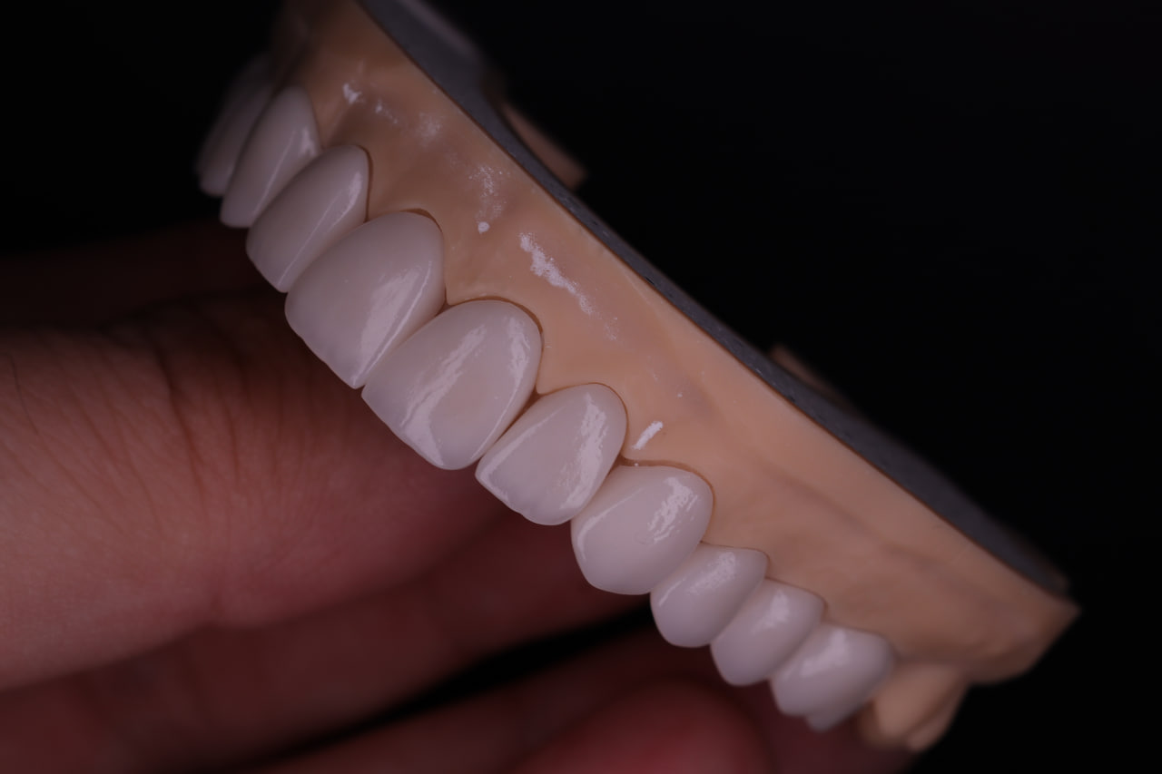 Emax Veneers